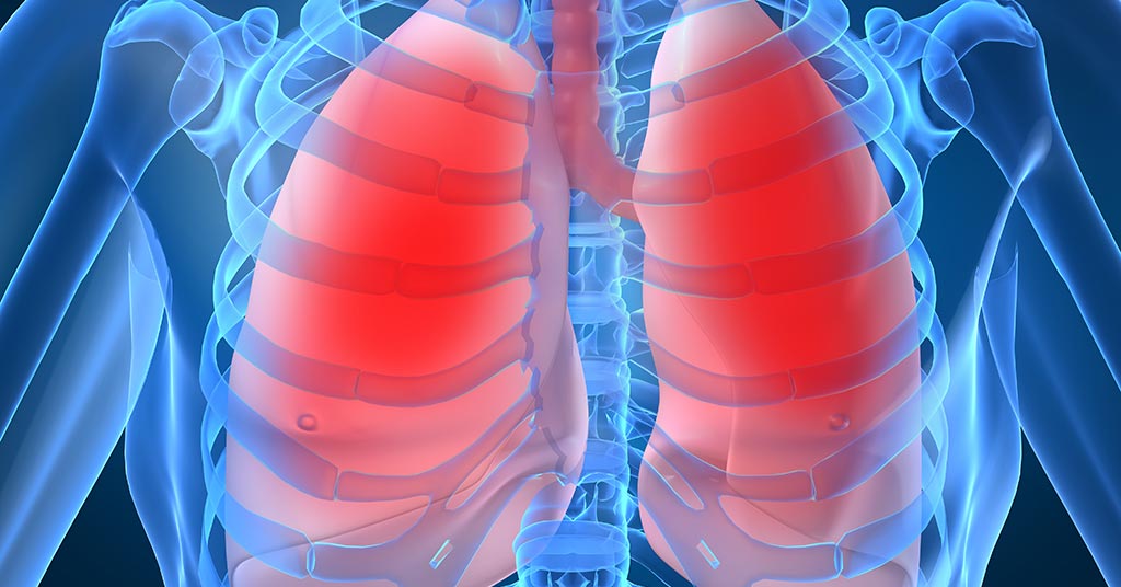bronchiectasis