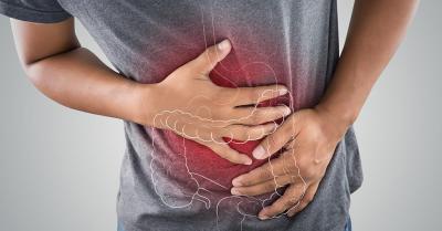 ulcerative colitis